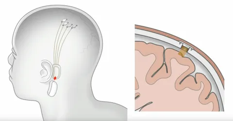 La Neuralink di Elon Mask comincia il suo trail sugli umani