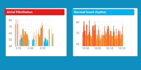 Apple Watch salva-vita: riconosce le anomalie del ritmo cardiaco