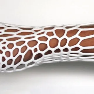 Gessi stampati in 3D per riparare le ossa rotte